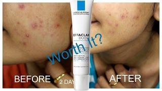 La Roche Posay Effaclar Duo Review  Worth it [upl. by The]